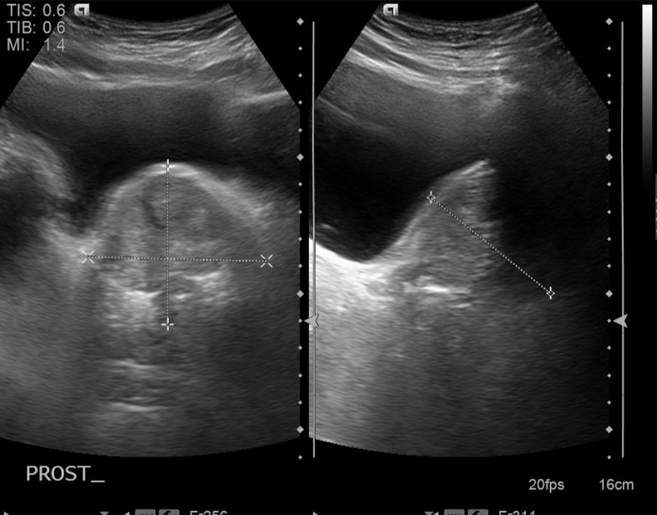 File:Cholecystitis - perforated gallbladder (Radiopaedia 57038-63913 A 25).jpg