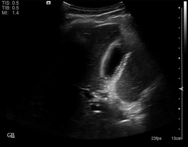 File:Cholecystitis - perforated gallbladder (Radiopaedia 57038-63913 A 9).jpg