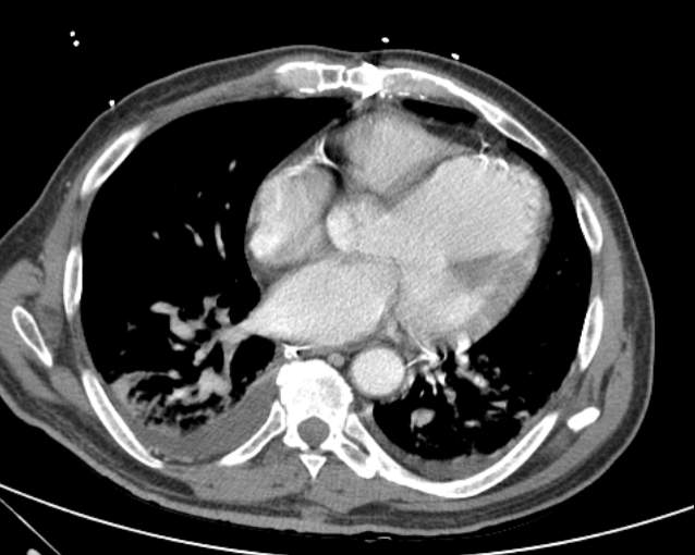 File:Cholecystitis - perforated gallbladder (Radiopaedia 57038-63916 A 5).jpg