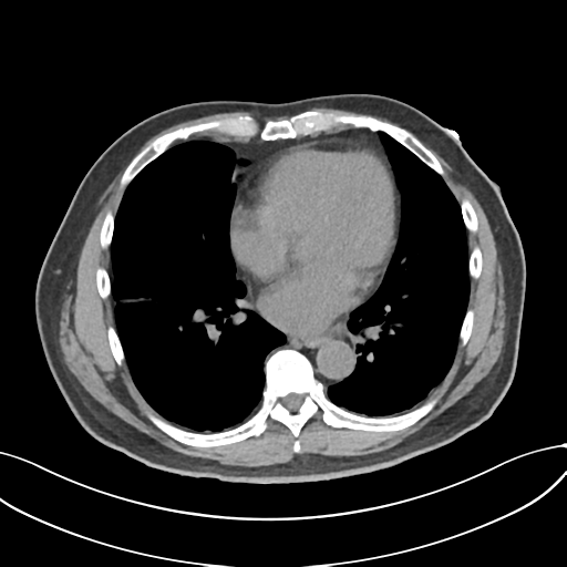 File:Cholecystitis with focal perforation and hepatic abscess (Radiopaedia 37189-38945 Axial non-contrast 1).png