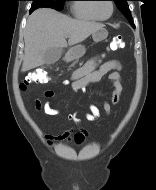 Cholecystitis with focal perforation and hepatic abscess (Radiopaedia 37189-38945 Coronal non-contrast 17).png