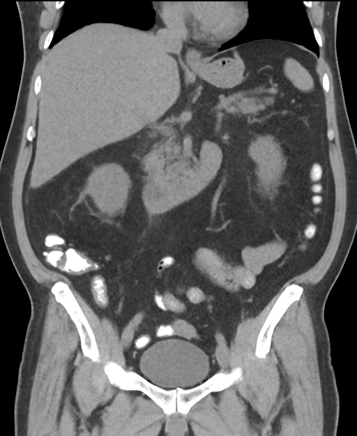 Cholecystitis with focal perforation and hepatic abscess (Radiopaedia 37189-38945 Coronal non-contrast 29).png