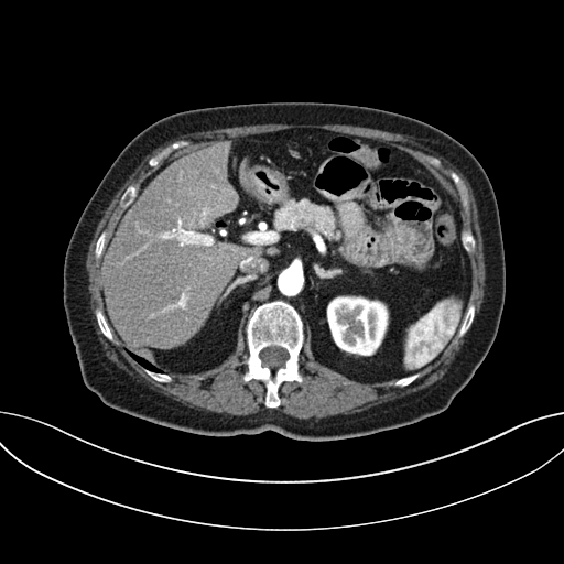 Cholecystoduodenal fistula due to calculous cholecystitis with gallstone migration (Radiopaedia 86875-103077 A 23).jpg