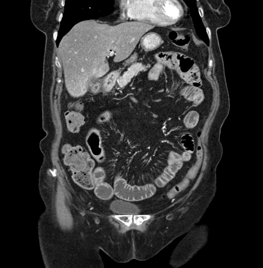File:Cholecystoduodenal fistula due to calculous cholecystitis with gallstone migration (Radiopaedia 86875-103077 B 15).jpg