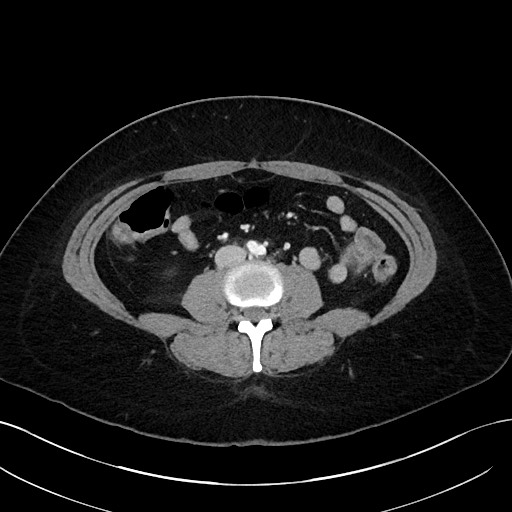 File:Choledocholithiasis after recent cholecystectomy (Radiopaedia 60929-68737 Axial 2).jpg