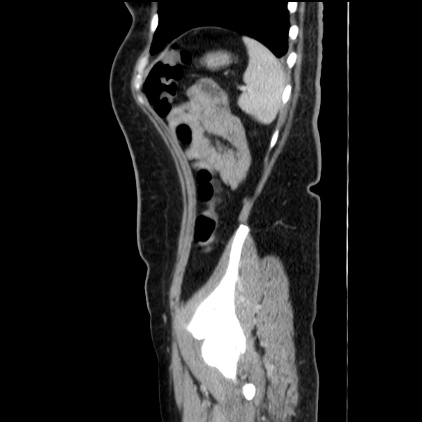 Choledocholithiasis on CT and MRI (Radiopaedia 24825-25087 D 52).jpg