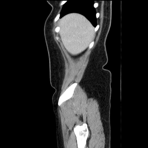 Choledocholithiasis on CT and MRI (Radiopaedia 24825-25087 D 9).jpg