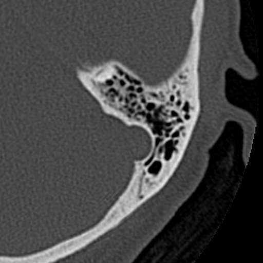 File:Cholesteatoma of the external ear (Radiopaedia 16540-16225 Axial bone window 10).jpg