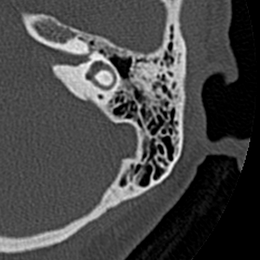 File:Cholesteatoma of the external ear (Radiopaedia 16540-16225 Axial bone window 17).jpg