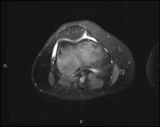 File:Chondroblastoma (Radiopaedia 62721-71031 Axial PD fat sat 13).jpg