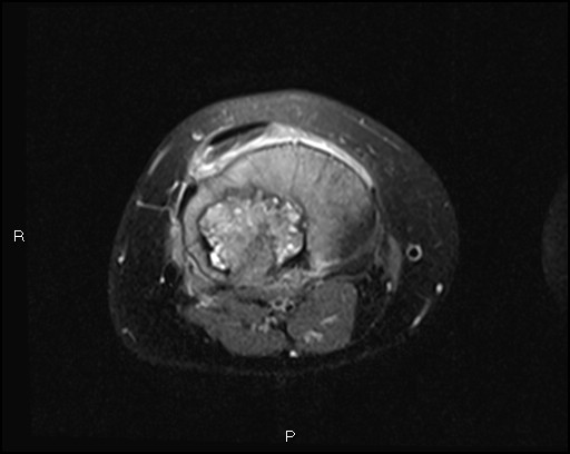 File:Chondroblastoma (Radiopaedia 62721-71031 Axial PD fat sat 22).jpg