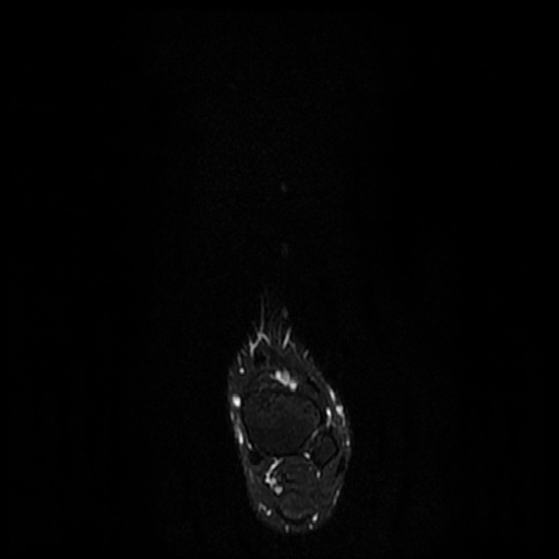 File:Chondroblastoma - midfoot (Radiopaedia 64831-73765 Long axis T2 fat sat 21).jpg