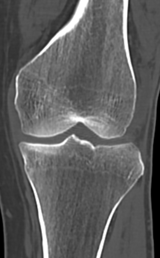 Chondrocalcinosis (Radiopaedia 82862-97173 Coronal bone window 41).jpg