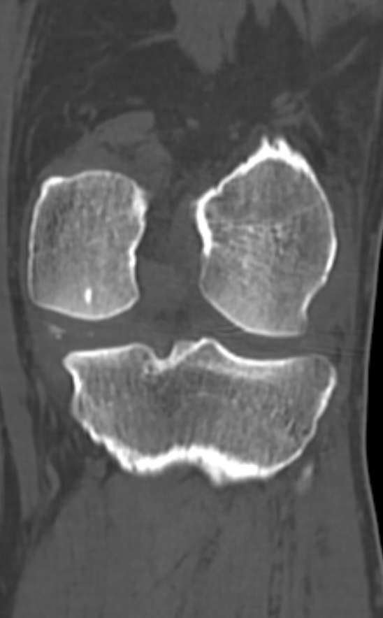 Chondrocalcinosis (Radiopaedia 82862-97173 Coronal bone window 53).jpg