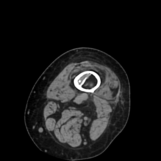 File:Chondrosarcoma - femur (Radiopaedia 64187-72954 Axial non-contrast 8).jpg