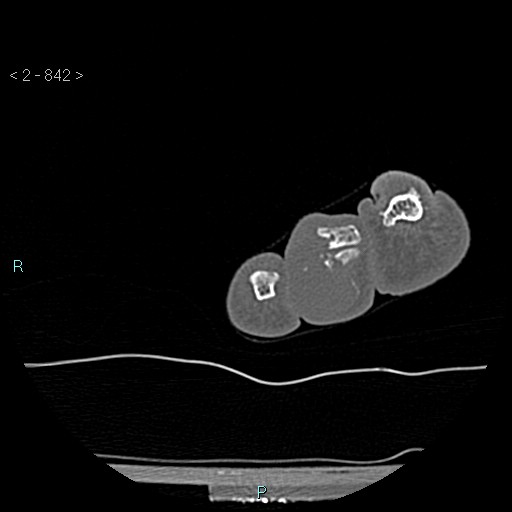 Chondrosarcoma - phalanx (Radiopaedia 69047-78812 Axial bone window 96).jpg