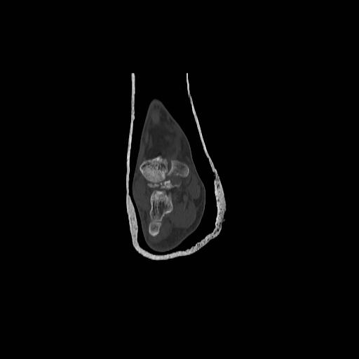 File:Chopart fracture (Radiopaedia 12386-12650 Coronal bone window 5).jpg
