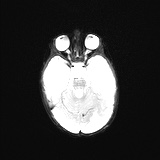 File:Choroid plexus papilloma (Radiopaedia 84612-100019 Axial DWI 9).jpg