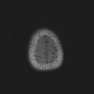 File:Choroid plexus papilloma (Radiopaedia 84612-100019 Axial T1 23).jpg