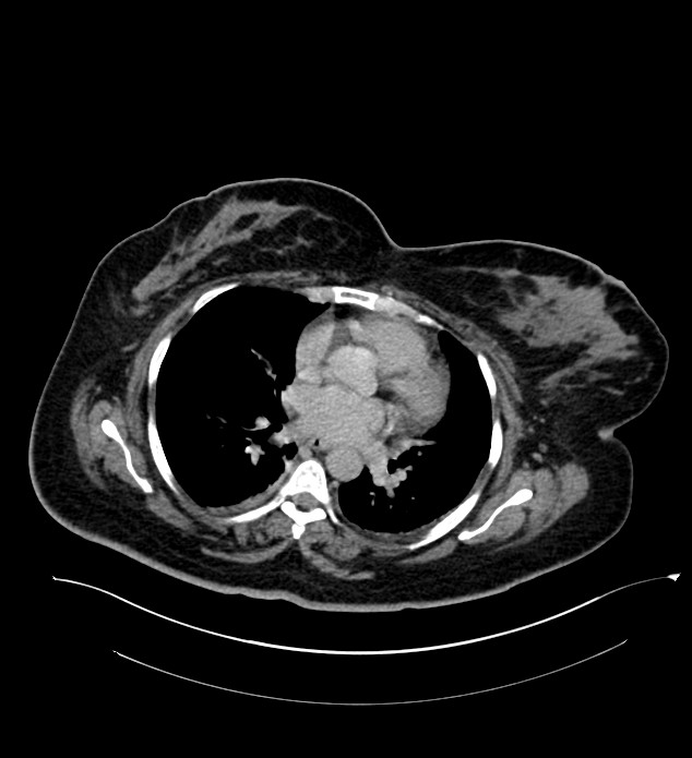Chromophobe renal cell carcinoma (Radiopaedia 84239-99519 E 7).jpg