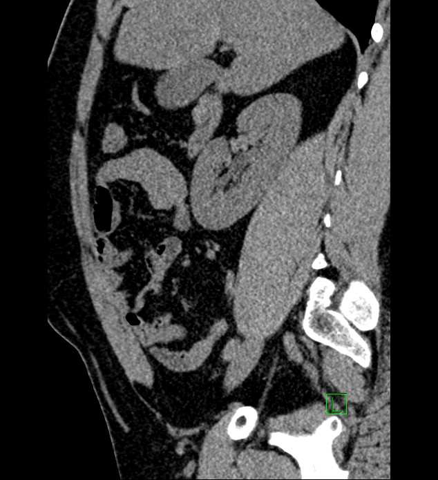 Chromophobe renal cell carcinoma (Radiopaedia 84286-99573 C 120).jpg