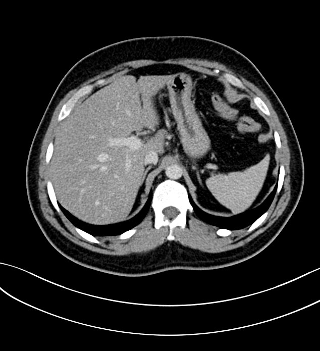 Chromophobe renal cell carcinoma (Radiopaedia 84286-99573 G 14).jpg