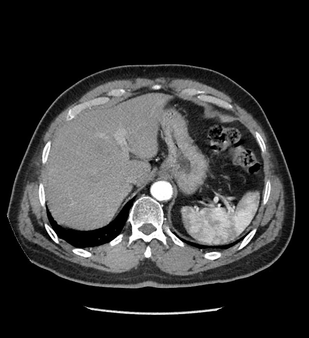 Chromophobe renal cell carcinoma (Radiopaedia 86879-103083 B 29).jpg