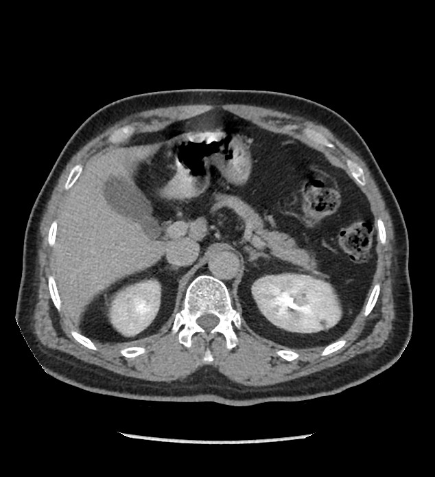 Chromophobe renal cell carcinoma (Radiopaedia 86879-103083 D 38).jpg