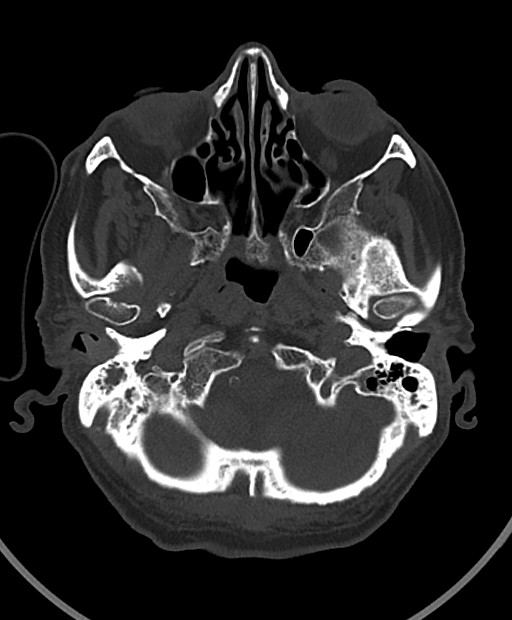 Chronic bilateral subdural hygroma (Radiopaedia 85801-101623 Axial bone window 101).jpg