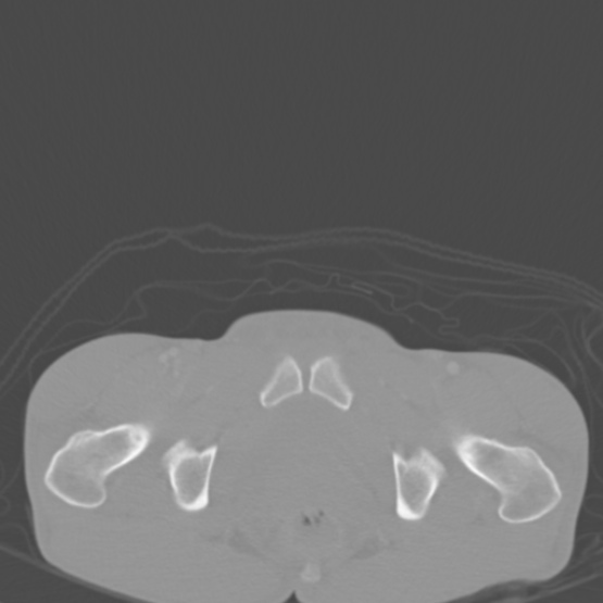 Chronic large bowel pseudo-obstruction (Radiopaedia 43181-46492 Axial bone window 162).jpg