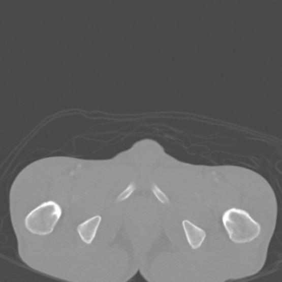 Chronic large bowel pseudo-obstruction (Radiopaedia 43181-46492 Axial bone window 167).jpg