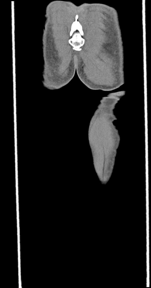 Chronic osteomyelitis (with sequestrum) (Radiopaedia 74813-85822 E 55).jpg