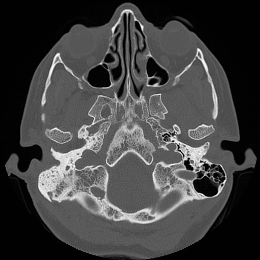 File:Chronic otomastoiditis (Radiopaedia 27138-27309 Axial bone window 12).jpg