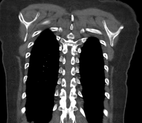File:Chronic pulmonary embolus (Radiopaedia 39129-41341 Coronal C+ CTPA 71).png