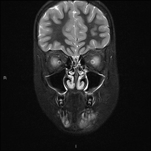 File:Chronic reactive multifocal osteomyelitis (CRMO) - mandible (Radiopaedia 56405-63069 Coronal STIR 10).jpg
