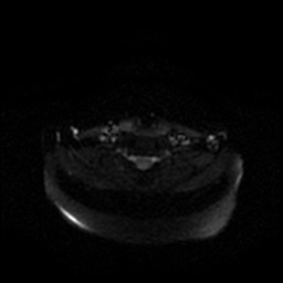 Chronic submandibular sialadenitis (Radiopaedia 61852-69885 Axial DWI 52).jpg