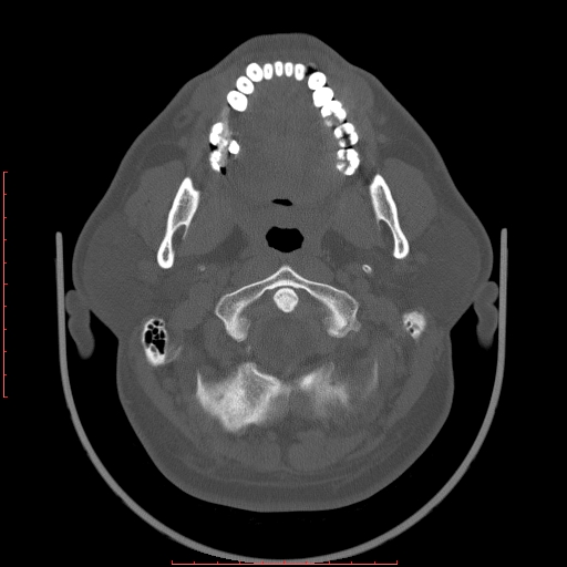 File:Chronic submandibular sialolithiasis (Radiopaedia 69817-79814 Axial bone window 24).jpg