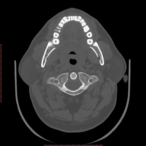 File:Chronic submandibular sialolithiasis (Radiopaedia 69817-79814 Axial bone window 36).jpg