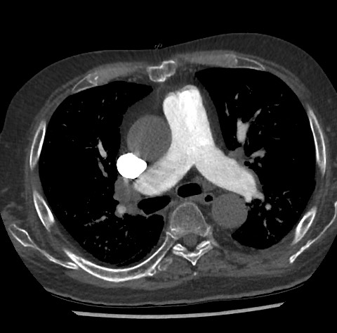 Chronic thromboembolic pulmonary disease (Radiopaedia 90694-108119 Axial C+ CTPA 43).jpg