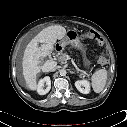 Cirrhosis and hepatocellular carcinoma in the setting of hemochromatosis (Radiopaedia 75394-86595 B 33).jpg