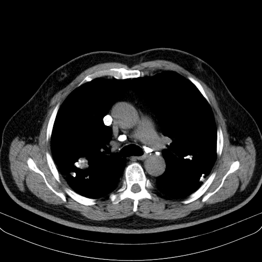 File:Classic complicated silicosis (Radiopaedia 49720-54961 Axial liver window 22).jpg