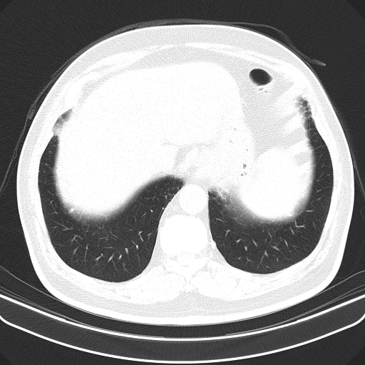 File:Classic complicated silicosis (Radiopaedia 49720-54961 Axial lung window 51).jpg