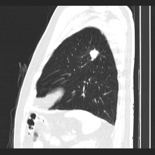 Classic complicated silicosis (Radiopaedia 49720-54961 Sagittal lung window 14).jpg