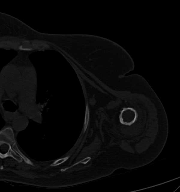 Clear cell chondrosarcoma - humerus (Radiopaedia 63104-71612 Axial bone window 67).jpg