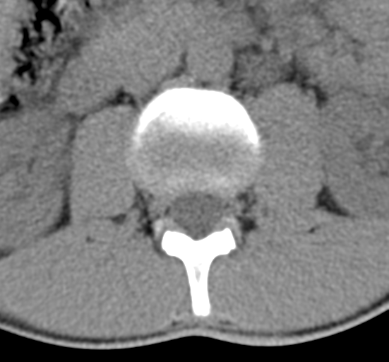 File:Clear cell meningoma - lumbar spine (Radiopaedia 60116-67691 Axial non-contrast 21).png