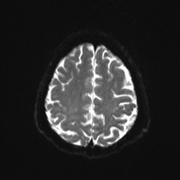 File:Clival meningioma (Radiopaedia 53278-59248 Axial DWI 20).jpg
