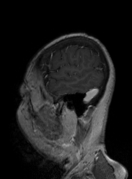 Clival meningioma (Radiopaedia 53278-59248 Sagittal T1 C+ 152).jpg