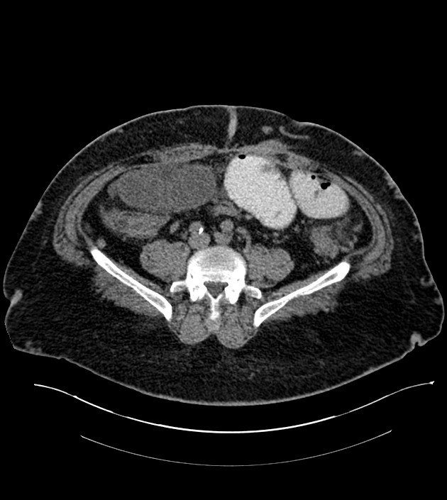 Closed-loop small bowel obstruction-internal hernia (Radiopaedia 78439-91096 Axial non-contrast 104).jpg