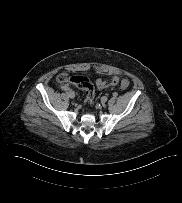 Closed-loop small bowel obstruction-internal hernia (Radiopaedia 78439-91096 Axial non-contrast 124).jpg