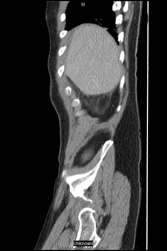 Closed loop bowel obstruction and ischemia (Radiopaedia 86959-103180 C 61).jpg